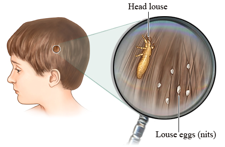 A visual representation of a kid with lice in his hair - the lice has laid eggs.